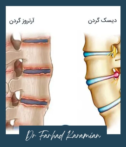 تفاوت با آرتروز گردن