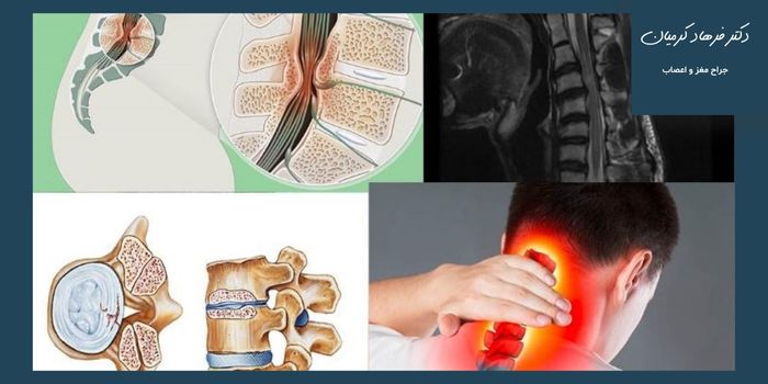 علل ایجاد تنگی کانال علل ایجاد تنگی کانال