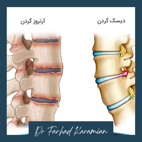 تفاوت دیسک‌ و آرتروز گردن