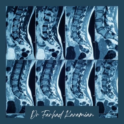 تشخیص دیسکهای ستون فقرات تشخیص دیسکهای ستون فقرات