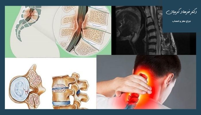 علل باریک شدن کانال نخاعی