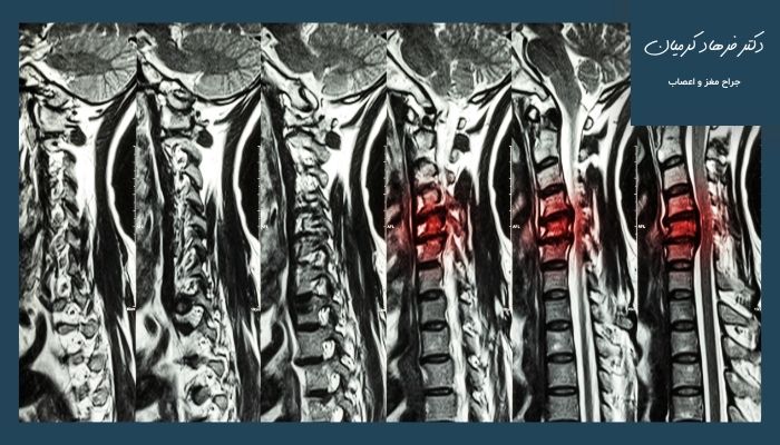 دلایل ایجاد دیسک بین مهره‌ای گردنی