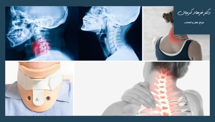 عوارض دیسک بین مهره‌ای گردنی