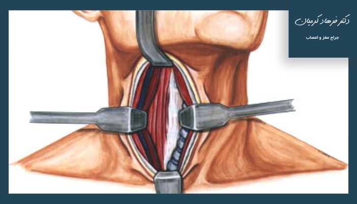 بعد از جراحی دیسک گردن چه نکاتی را باید رعایت کرد؟ بعد از جراحی دیسک گردن چه نکاتی را باید رعایت کرد؟